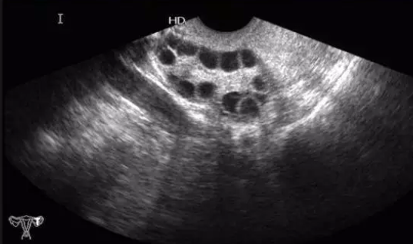 卵巢在B超下的样子