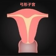 弓形子宫是什么意思？能正常怀孕生育吗？