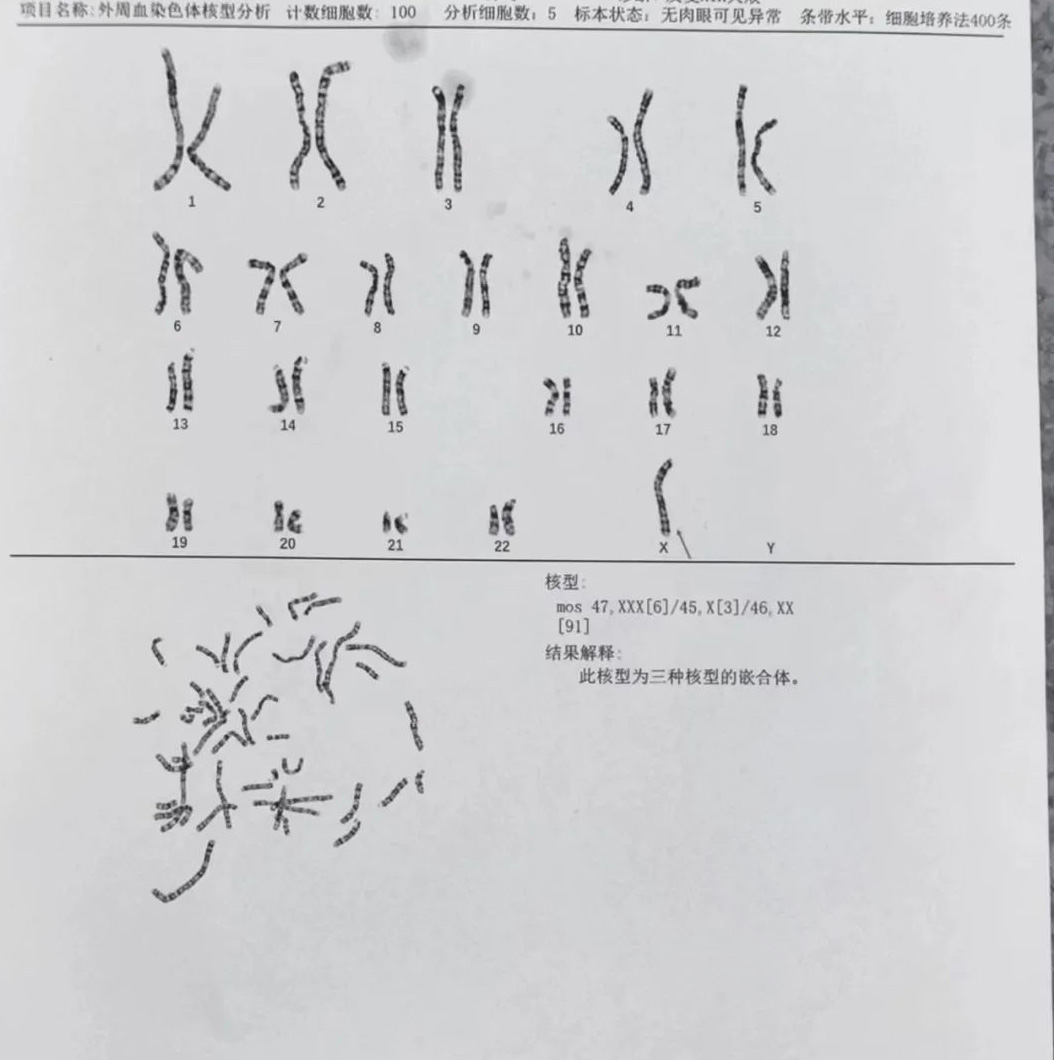 染色体嵌合体检查报告