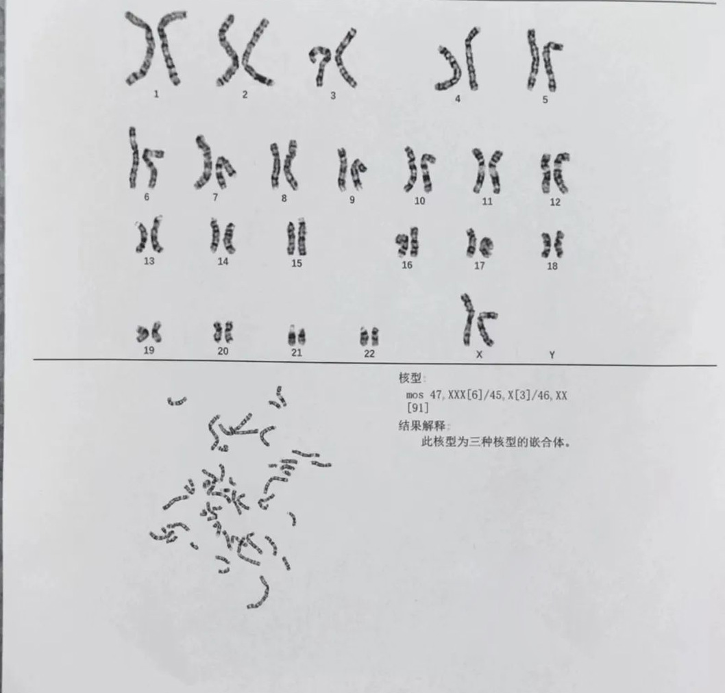 染色体嵌合体检查报告